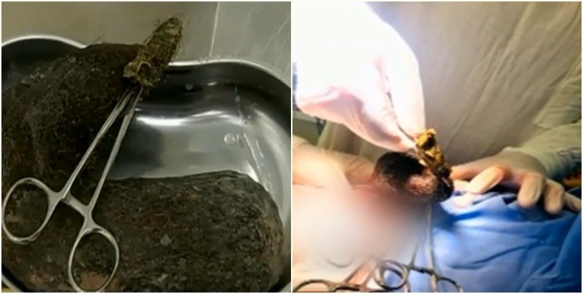 Алматыда қыздың асқазанынан 1 келі шаш шықты