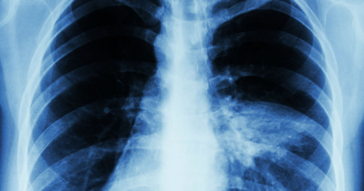 Көкшетауда әскери бөлім сарбаздары пневмониямен ауруханаға түсті