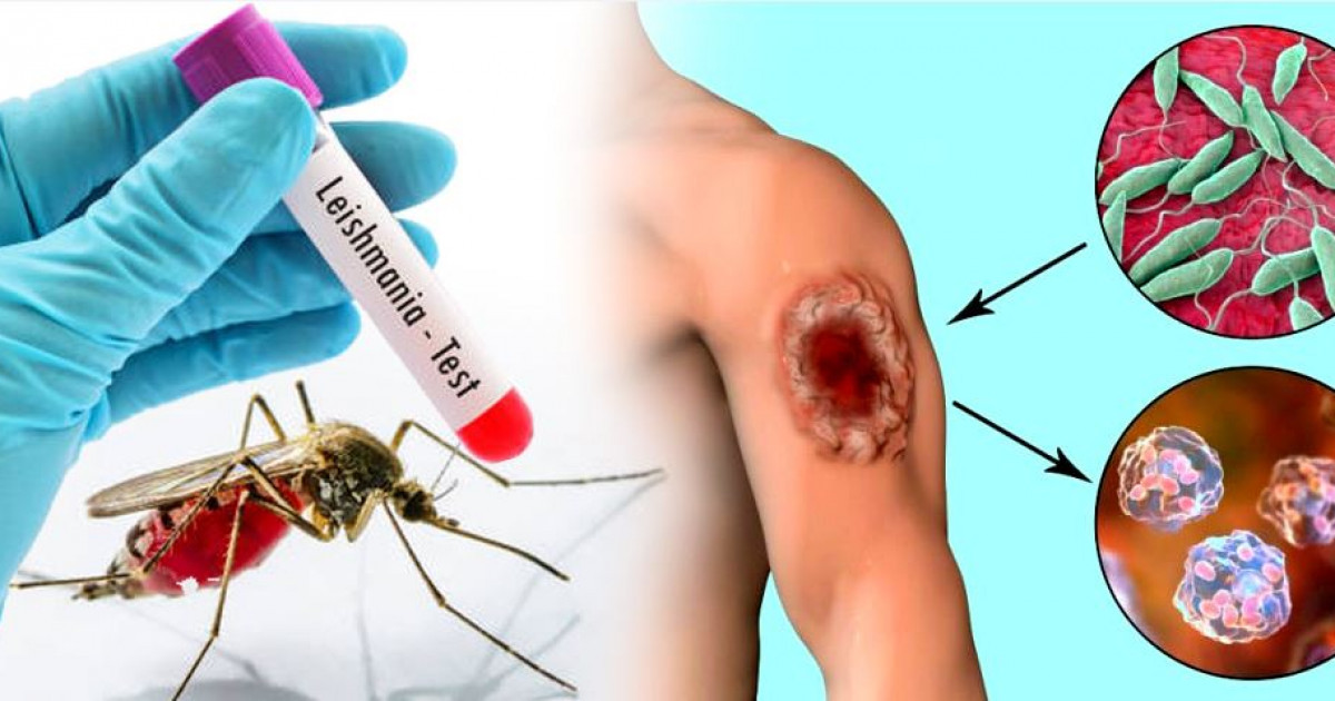 Отырарлықтар лейшманиозден қашан құтылады?