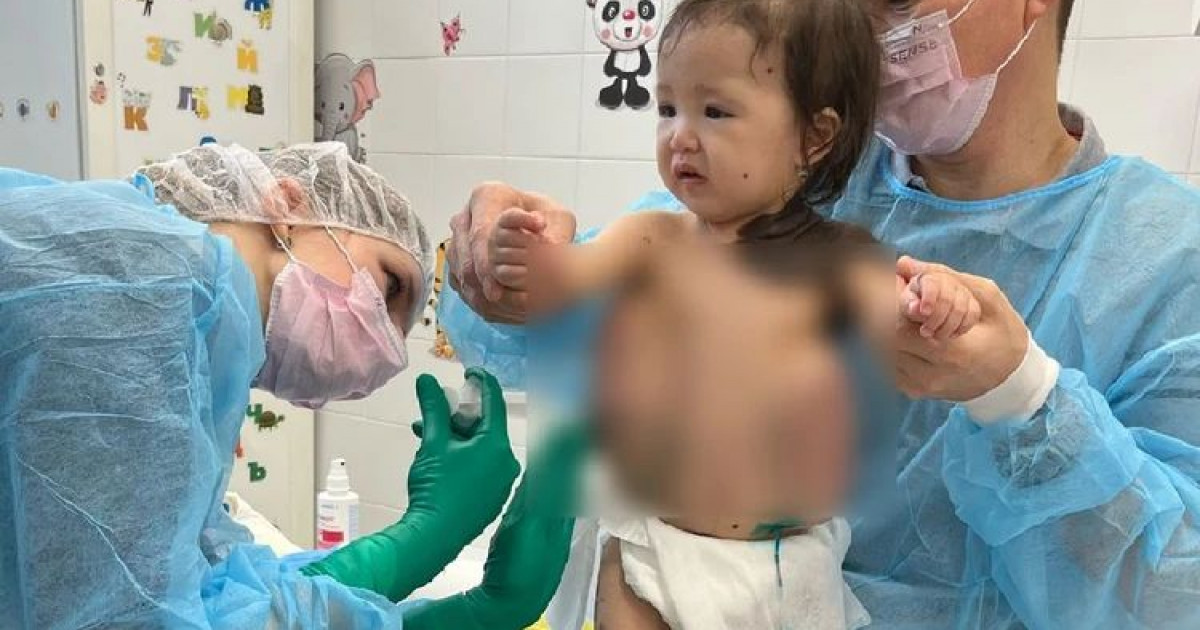 Денесінің 80 пайызын мең басқан: бір жасар қызға ерекше ота жасалмақ