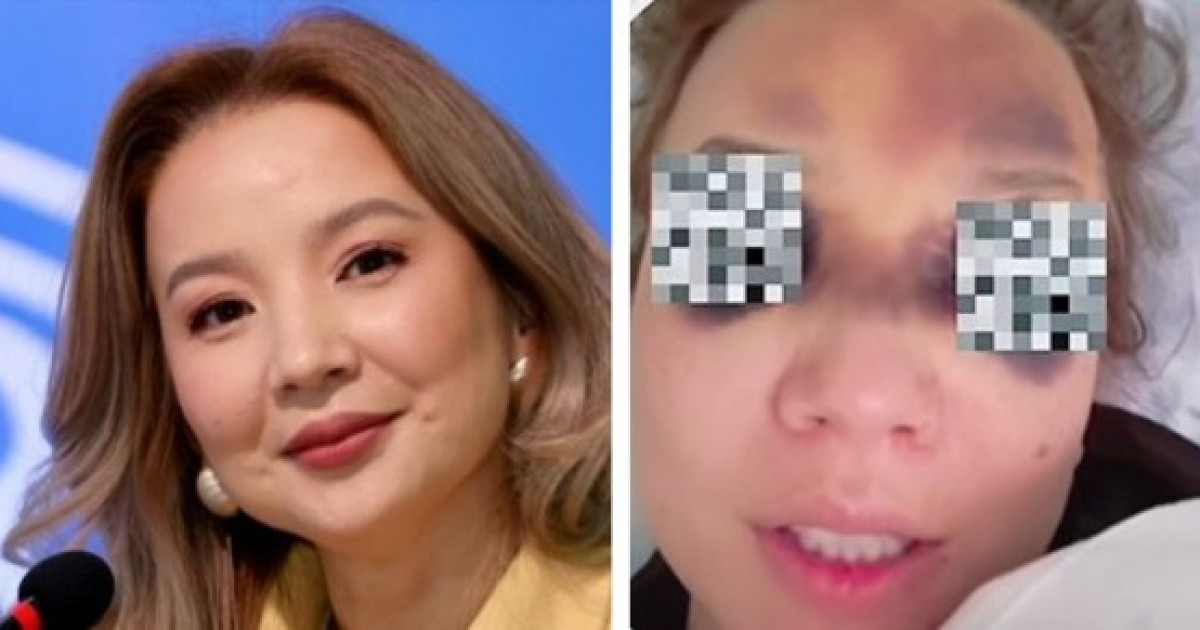 «Аман қалғаныма шүкір»: Әйкерім Есенәлі ауыр жарақат алғанын айтты