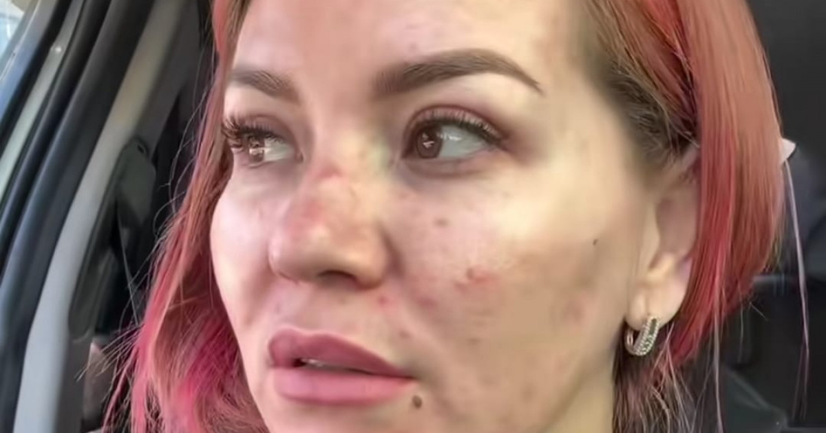 «Енді қалай емдеймін?» Әсел Асқардың жарнамасына сенген қыздың беті бөртіп кеткен